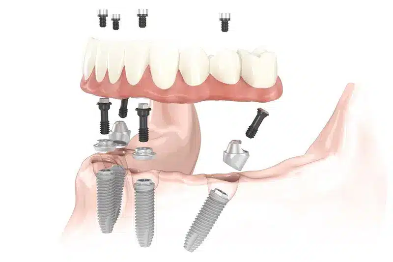 All on 4 implantati Zaprešić - zubar Zaprešić