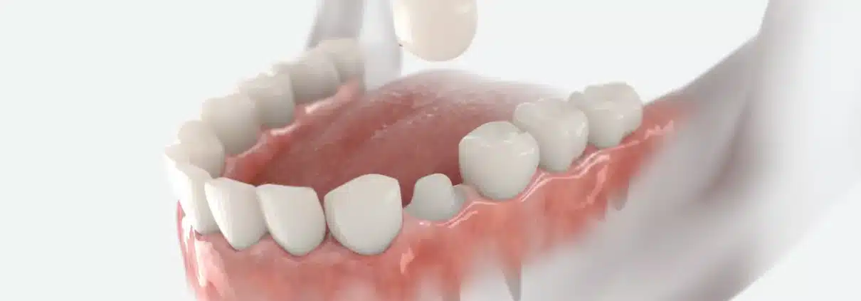 Navlake za zube Zaprešić - Ordinacija dentalne medicine Vedran Šebečić