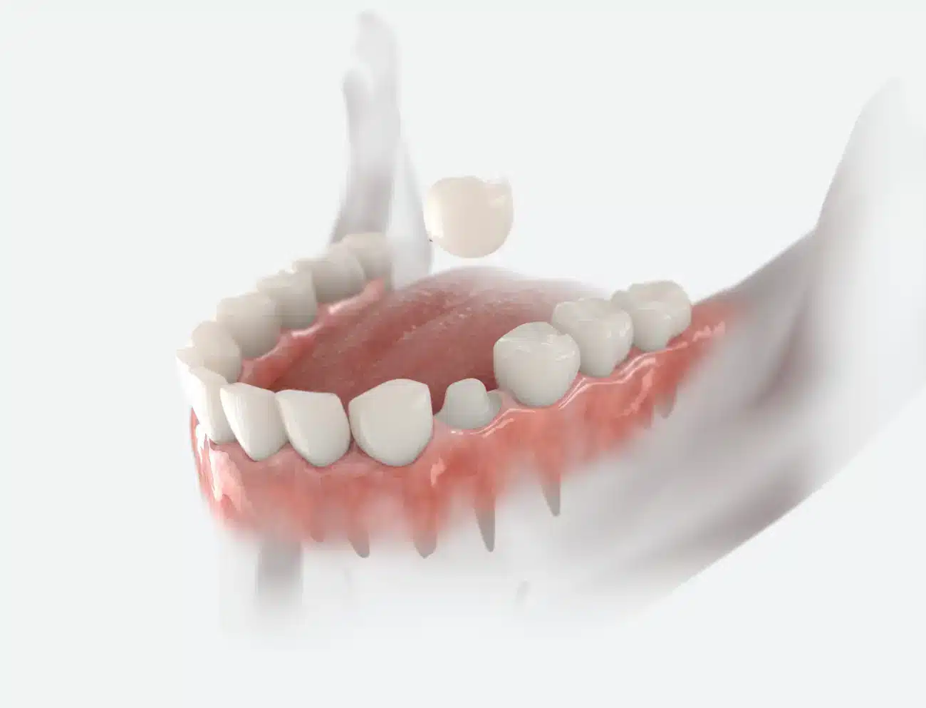 Navlake za zube Zaprešić - Ordinacija dentalne medicine Vedran Šebečić