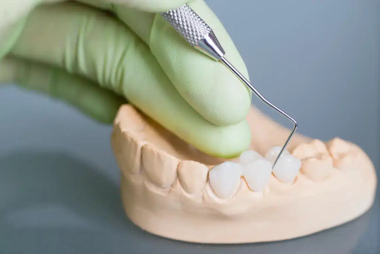 zubni most Zaprešić - Ordinacija dentalne medicine Vedran Šebečić